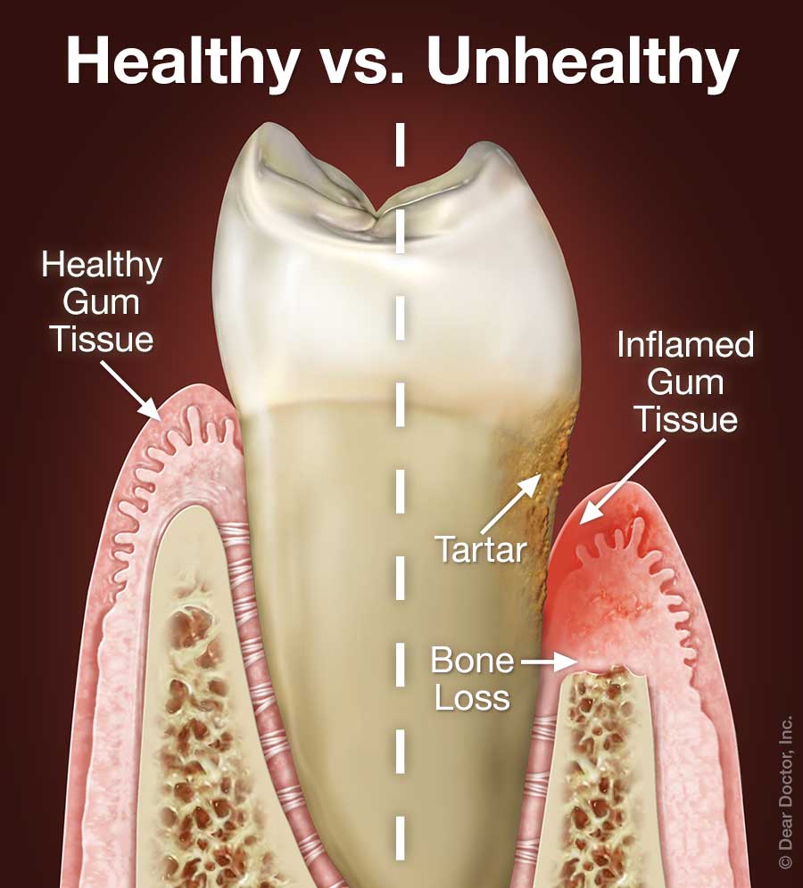 Periodontal Gum Disease | Coastal Periodontics & Implant Dentistry | Mobile  Alabama